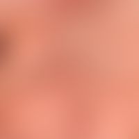 Varicella: generalized exanthema with juxtaposition of vesicles, papules, papulopustules, here in...