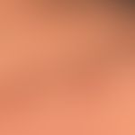 Varizellen:&nbsp;generalisiertes Exanthem; neben einer älteren, bereits abgetrockneten Vesikel (u...