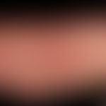 Verätzung:&nbsp;&nbsp;Multiple, scharf begrenzte Erosionen und flache Ulzerationen am Oberschenke...