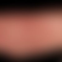 Verätzung:&nbsp;&nbsp;Multiple, scharf begrenzte Erosionen und flache Ulzerationen am Oberschenke...