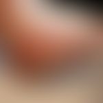 Eczema and ulcerations in an arthrogenic stasis syndrome, here in postthrombotic syndrome after a...