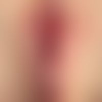 Lichen sclerosus der Vulva und des Anus. 7-jähriges Mädchen. Massive dermatitische Reaktion mit s...