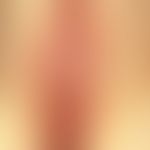 Intertriginous psoriasis in an 11-year-old girl with infestation of the labia and perianal region...