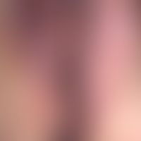 Chronische therapieresistente vulvovaginale Candidose seit&nbsp;12 Monaten. Abheilung erst unter ...