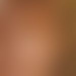 Itching due to oxyur infestation. a pinworm female is visible on the reddened perianal skin. Fig....