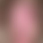 Lichens implex chronicus der Vulva bei einer 40-jährigen Patientin. Flächige Rötung Lichenifikati...