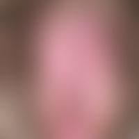 Lichens implex chronicus der Vulva bei einer 40-jährigen Patientin. Flächige Rötung Lichenifikati...