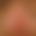Lichen planus der Vulva: seit Monaten Juckreiz. 35-jährige Patientin mit bds. durch Pfeile markie...