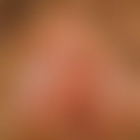 Lichen planus der Vulva: seit Monaten Juckreiz. 35-jährige Patientin mit bds. durch Pfeile markie...