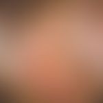 Fortgeschrittener, unbehandelter Lichen planus der Vulva bei eienr 59-jährigen Patientin. Starker...