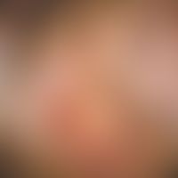 Fortgeschrittener, unbehandelter Lichen planus der Vulva bei eienr 59-jährigen Patientin. Starker...