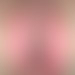 Intertriginous psoriasis of the vulva and immediate perivulvary region. 35-year-old woman. Fig. f...