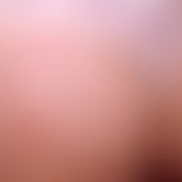 Herpes simplex recidivans: in loco recurrent herpes simplex. Fig.from Eiko E. Petersen, Colour At...