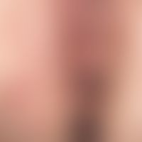 Zoster der rechten Vulvaseite. 52-Jahre alte, ansonsten gesunde&nbsp;Patientin. Abb. aus&nbsp;Eik...