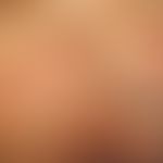 Trichomoniasis mit schwerer, mehrfach mit Antibiotika vorbehandelter Vulvitis. 62-Jahre alte Pati...