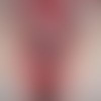 Rezidivierende, perianale Dermatitis und Vulvitis durch A-Streptokokken. 36-Jahre alte Patientin....