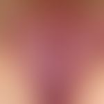 Kumulativ toxische Kontaktdermatitis durch exzessive Überwaschen der Genitalregion. Besserung nac...