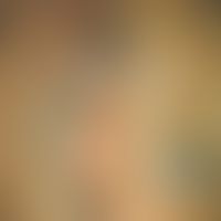 Varicosis of the vulva in the 38th week of pregnancy. 24-year-old female patient. Complete regres...