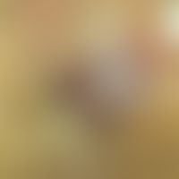 &nbsp;Akute Analvenenthrombose bei 32-Jahre alten&nbsp;Schwangeren&nbsp;in der 28.SSW&nbsp;.&nbsp...