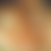 Bumpy Bartholin cyst on the right side in a 29-year-old female patient. The opening of the excret...