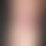 Erythema chronicum migrans: &nbsp;vor 14 Tagen Zeckenstich. Persistierende Stichreaktion mit kont...