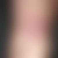 erythema chronicum migrans: 14 days ago tick bite. persistent bite reaction with continuous devel...