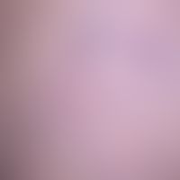 Anaesthesia: Pronounced reticular varices (spider veins), which start from a sack-shaped dilated ...