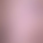 Spider veins, also called reticular varices, an intradermal buttock dilatation, here starting fro...