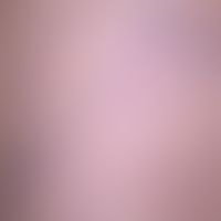 Spider veins, also called reticular varices, an intradermal buttock dilatation, here starting fro...