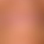 Lichtalterung: schwere aktinische Elastose mit chronischer Cheilitis solaris und Vitilligo.
