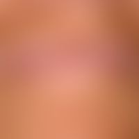 Lichtalterung: schwere aktinische Elastose mit chronischer Cheilitis solaris und Vitilligo.
