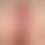 Hidradenitis suppurativa, a progressive and extensive finding with papules, pustules, nodules, in...