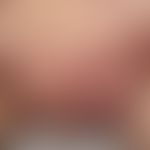 Hidradenitis suppurativa, a widespread and progressive condition with papules, pustules, nodules,...