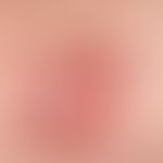 Nodules: coarse, smooth, hairless nodule underlaid with a skin-coloured coarse plaque Dermatofibr...