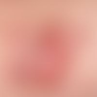 Nodules: coarse, smooth, hairless nodule underlaid with a skin-coloured coarse plaque Dermatofibr...