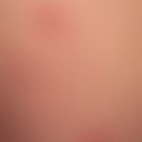Erythema multiforme: sharply defined, reddish plaque with central blister formation.
