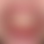 Stevens-Johnson-Syndrom: akut aufgetretene, großflächige, schmerzhafte Erosionen an Lippenrot, an...