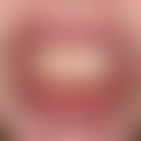 Stevens-Johnson-Syndrom: akut aufgetretene, großflächige, schmerzhafte Erosionen an Lippenrot, an...