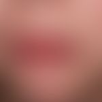 Stevens-Johnson-Syndrom: akut aufgetretene, großflächige, schmerzhafte Erosionen an Lippenrot, an...