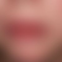 Stevens-Johnson-Syndrom: akut aufgetretene, großflächige, schmerzhafte Erosionen an Lippenrot, an...
