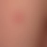 Bladder: Shooting target like aspect of the (subepithelial) bladder in erythema multiforme.
