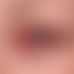 Stevens-Johnson-Syndrom: akute, schwere, schmerzhafte, mit erheblicher Lichtscheu einhergehende, ...