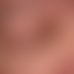 Syringome disseminierte: multiple, dicht aneinanderstehende, stellenweise konfluierte (oberer Orb...