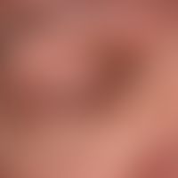 Syringome disseminierte: multiple, dicht aneinanderstehende, stellenweise konfluierte (oberer Orb...