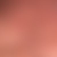 Syringome disseminated: (detailed view of the scrotum); since about 2 years, imperceptibly multip...