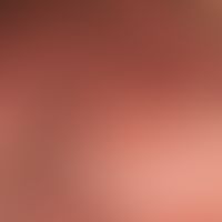 Syringome disseminated: (detailed view of the scrotum); since about 2 years, imperceptibly multip...