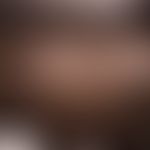 Syringome disseminierte: etwa 0,2 cm große, festes, gelblic-braunes, oberflächenglattes Knötchen....