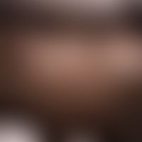 Syringomas disseminated: about 0.2 cm large, firm, yellowish-brown, surface-smooth nodule; no itc...