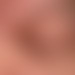 Syringome disseminierte: multiple, dicht aneinanderstehende, stellenweise konfluierte (oberer Orb...
