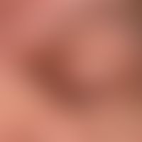 Syringome disseminierte: multiple, dicht aneinanderstehende, stellenweise konfluierte (oberer Orb...